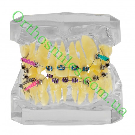 Типодонт (модель зубів) з брекетами фото 1 — OrthoSmiles