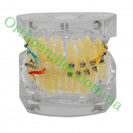 Типодонт (модель зубів) з комбінованими  брекетами фото 1 — OrthoSmiles