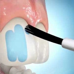 Фіксуючі матеріали для стоматології: фото